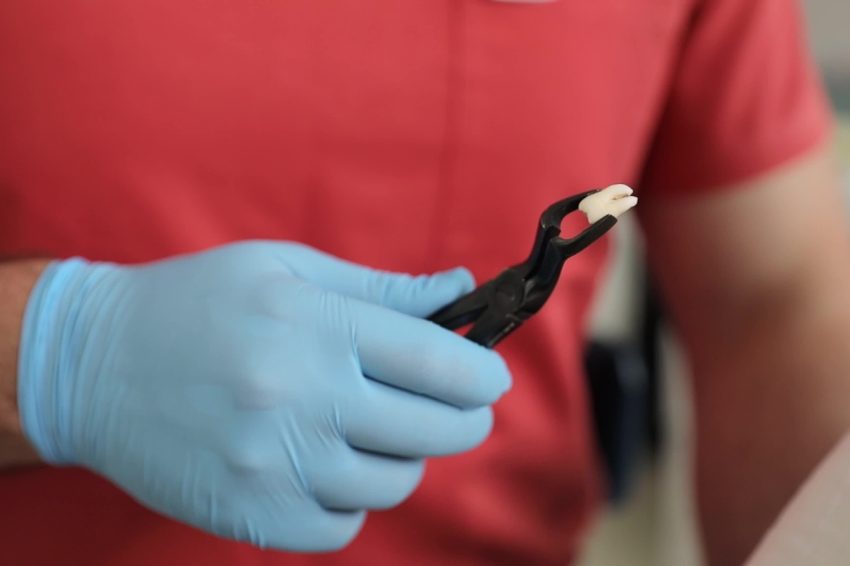 Image d’une personne tenant une dent avec des pinces.